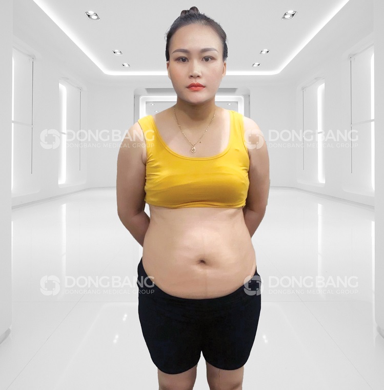 Chị Hiền trước khi thực hiện giảm béo tại Dongbang