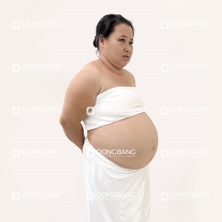 Bạn có thể thấy chị Hiền trước khi giảm béo với vòng bụng ngoại cỡ, chảy xệ, mỡ dày