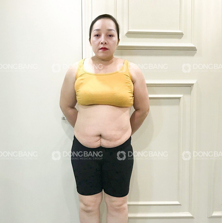 Chị Hà trước khi giảm cân