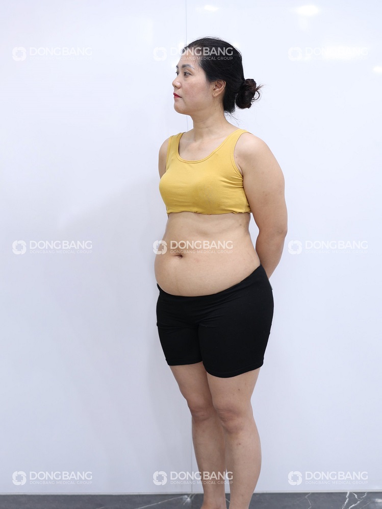 Chị Như Lệ nặng 63kg, vòng eo 89cm trước khi giảm cân