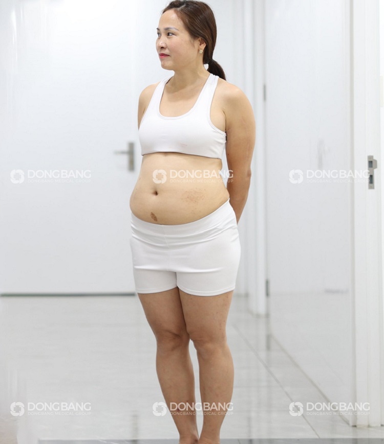 Chị Mai Hiên trước khi giảm béo nặng 65kg, vòng eo 85cm