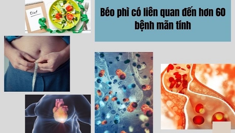 số liệu thống kê của bệnh béo phì