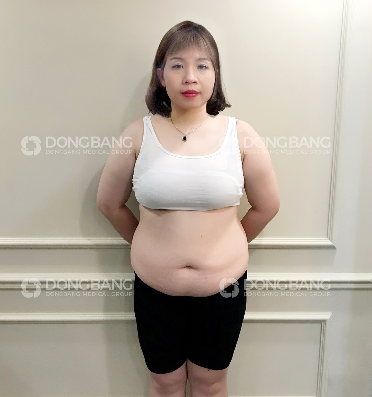 Chị Uyên bị tăng cân không kiểm soát, với những vết rạn da, bụng ngấn mỡ