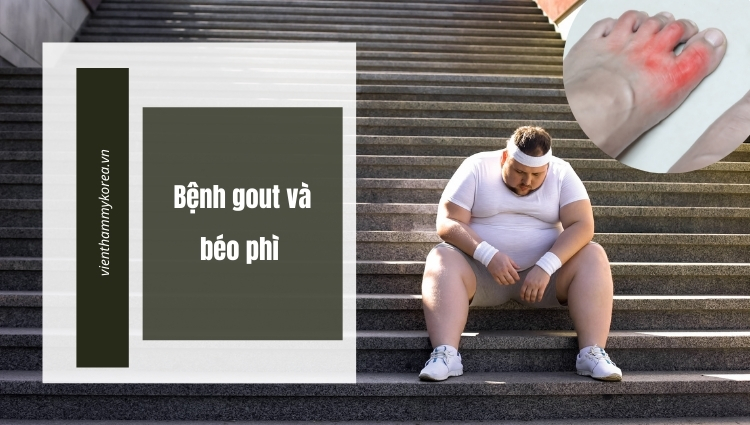 Béo phì và gout 