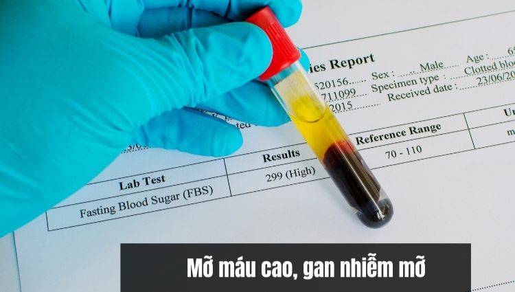 Béo phì dẫn đến mỡ máu, gan nhiễm mỡ cao