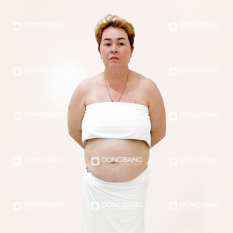 Chị Liễu trước khi giảm béo tại Dongbang