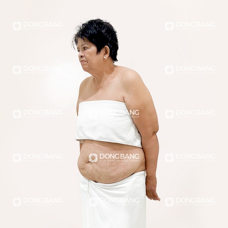 Cô Dung trước khi giảm béo