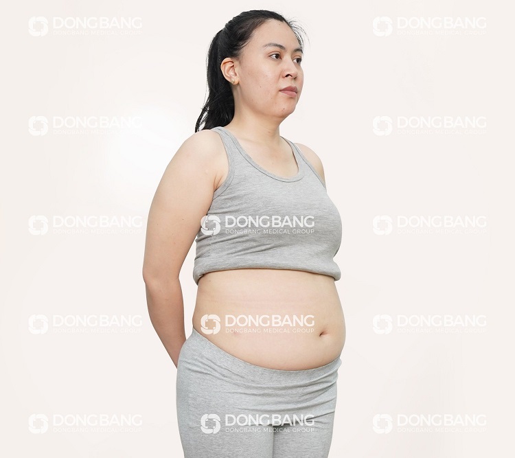 Chị Ngân trước khi giảm béo tại Viện thẩm mỹ Dongbang 