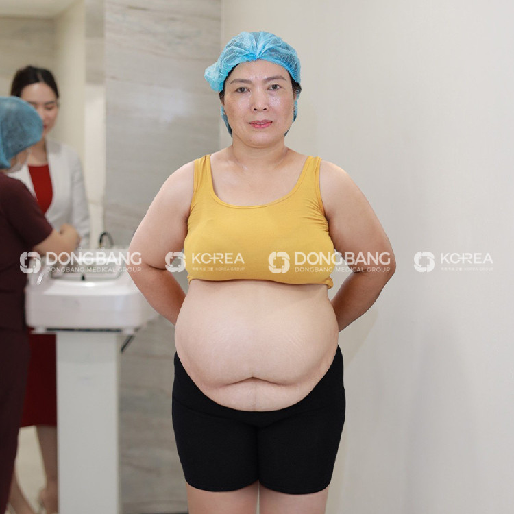 Cô Thanh Xuân trước khi đến Viện thẩm mỹ Dongbang giảm béo