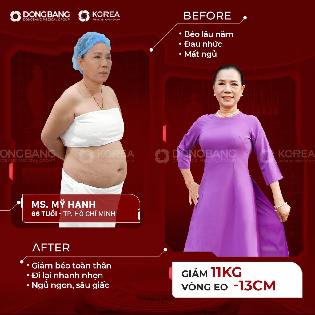 Hình ảnh cô Mỹ Hạnh trước và sau khi giảm cân tại Viện thẩm mỹ Dongbang