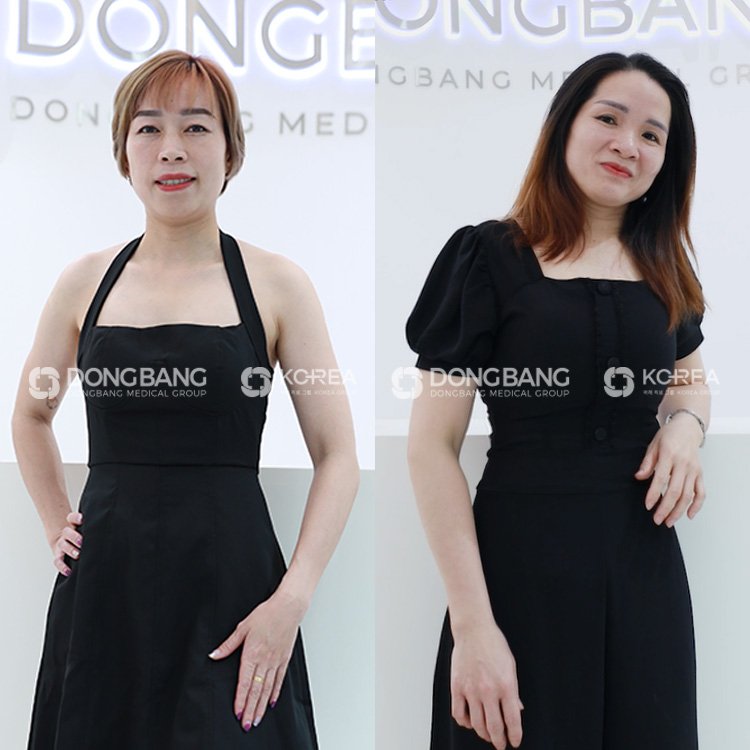 Hình ảnh 2 chị sau khi giảm cân tại Viện thẩm mỹ Dongbang 