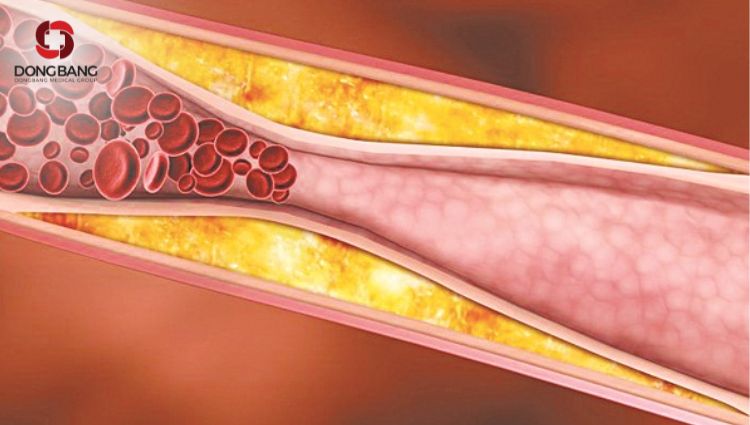 Giới tinh, độ tuổi, di truyền hay lối sống đều có nguy cơ gây ra mỡ máu cao